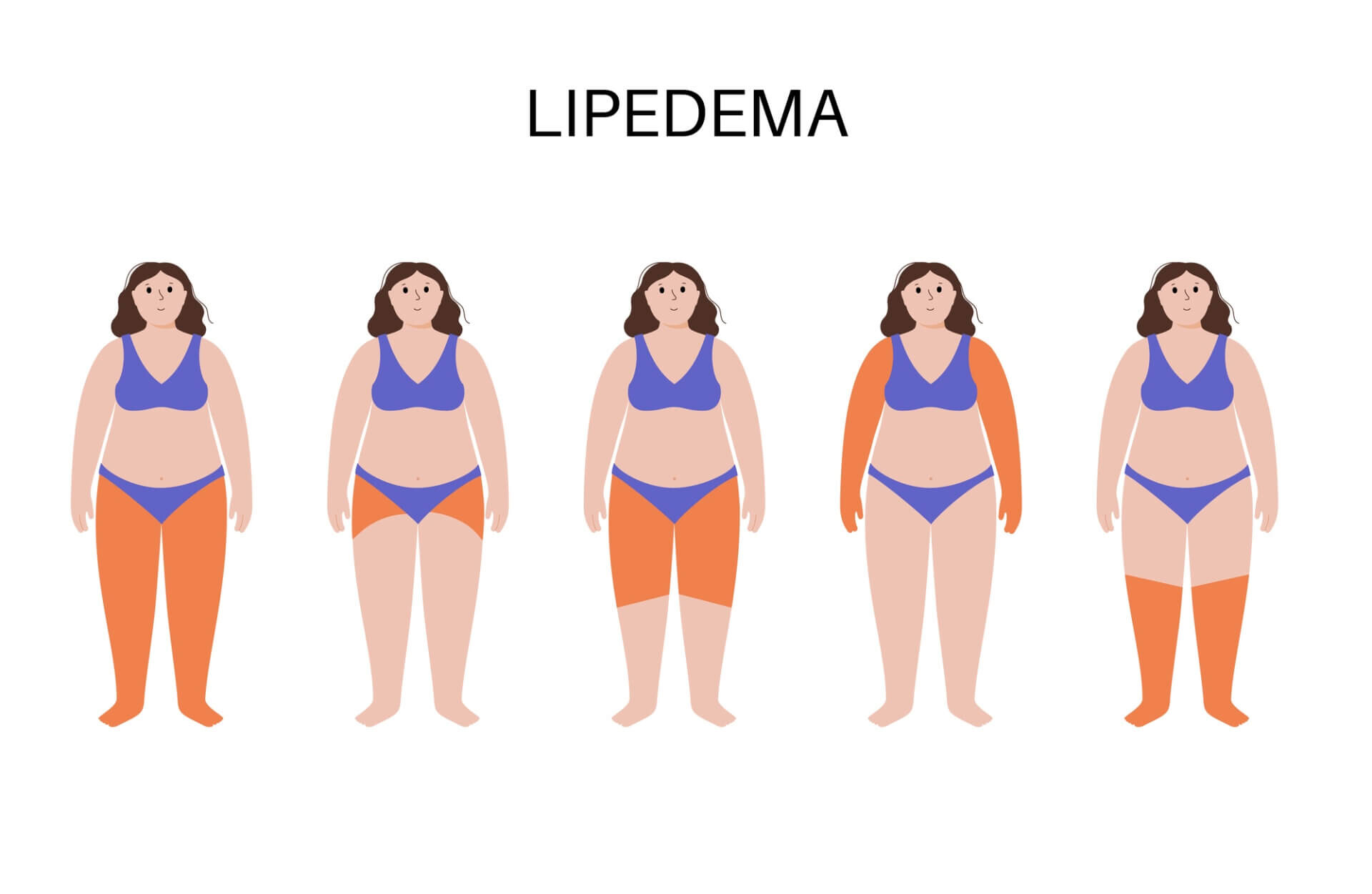Ilustração representando as potenciais formas de lipedema em mulheres.