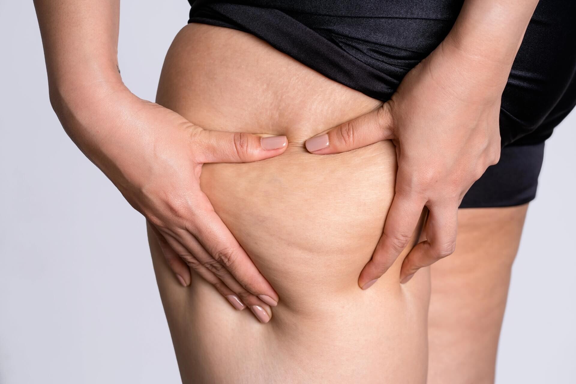 Lipedema: sofre com pernas inchadas e dolorosas? Pode não ser só retenção de líquidos