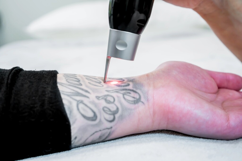 Remoção de Tatuagens nas Clínicas Persona